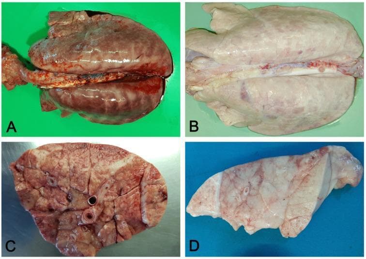 This composite of clinical photographs illustrates the macroscopic pathology of interstitial pneumonia, contrasting acute and chronic stages through gross specimens. Panels A and C represent the acute phase, showing lungs that fail to collapse and exhibit prominent rib impressions on the pleural surface. The parenchyma is characterized by diffuse hyperemia, giving it a dark red, mottled appearance, and interstitial edema within the perilobular connective tissue, which increases the overall firmness and weight of the organ. Panels B and D demonstrate the chronic stage of the disease. In this phase, the lungs remain non-collapsed with persisting rib impressions, but the color shifts to a pale, whitish-grey hue. This chromatic change reflects the progression to interstitial fibrosis and a further increase in tissue consistency. The specimens lack significant airway exudate, a hallmark distinguishing interstitial pneumonia from bronchopneumonia. This visual resource is intended for medical education in pathology and pulmonology to aid in identifying the gross morphological markers of lung injury progression from acute inflammation to chronic fibrotic remodeling.