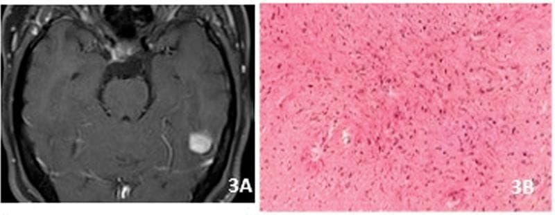This composite educational figure illustrates the neuroimaging and histopathological features of a pilocytic astrocytoma (WHO Grade 1). Panel A displays an axial T1-weighted post-gadolinium MRI of the brain, showing a discrete, well-circumscribed, intensely enhancing nodular lesion located in the temporal lobe. Notably, there is an absence of perilesional vasogenic edema or significant mass effect on the adjacent parenchyma. Panel B provides a corresponding high-magnification light microscopy view of the tumor using Hematoxylin and Eosin (H&E) staining. The histology demonstrates a classic biphasic pattern characterized by 'piloid' cells—astrocytes with elongated, hair-like bipolar processes. Diagnostic hallmarks visible include Rosenthal fibers, which appear as brightly eosinophilic, worm-like proteinaceous aggregates, and a background of fibrillary matrix. These visual findings correlate with the slow-growing, benign nature of this pediatric-type diffuse low-grade glioma, frequently associated with MAP kinase pathway alterations.