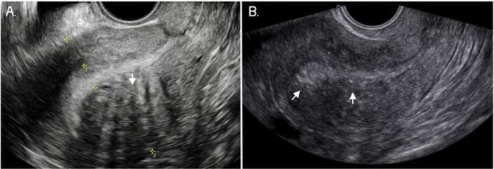 This diagnostic image consists of two grayscale panels (A and B) showing two-dimensional transvaginal ultrasound (TVUS) scans of a uterus in longitudinal section, demonstrating classic sonographic features of adenomyosis. Panel A illustrates marked myometrial asymmetry, where the posterior uterine wall is significantly thicker than the anterior wall. The myometrium exhibits a heterogeneous echo texture, characterized by prominent hypoechoic linear striae (fan-shaped shadowing) marked with arrows, representing subendometrial glandular invasion. Panel B focuses on the internal architecture of the uterine wall, highlighting a poorly defined junctional zone (JZ). White arrows point to the blurred, irregular interface between the endometrium and the underlying myometrium, which lacks a distinct, measurable boundary. These findings are key diagnostic criteria established by the Morphological Uterus Sonographic Assessment (MUSA) group for identifying adenomyosis. The images serve as an educational resource for gynecological radiology and ultrasound technicians to recognize signs of diffuse myometrial disease and uterine wall disproportion.