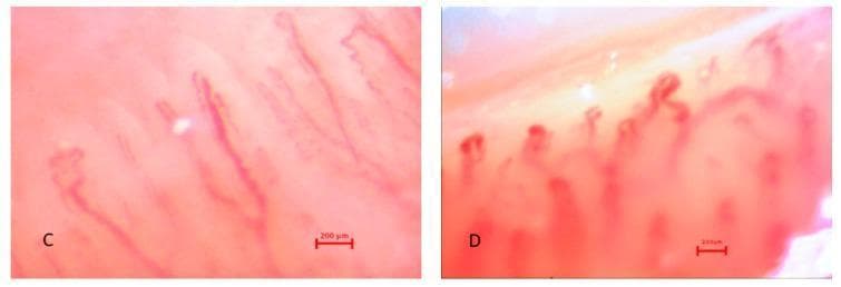 This clinical diagnostic image displays nailfold capillaroscopy frames (C and D) illustrating microvascular patterns in patients with Raynaud's Phenomenon (RP). Frame C shows spastic capillary loops characterized by elongated, slender, and relatively linear structures with mild tortuosity and organized, parallel arrangement. Frame D demonstrates advanced pathological changes, including 'giant capillaries' with significantly enlarged diameters, irregular bulbous shapes, and a disorganized, clustered spatial distribution. The imaging utilizes in vivo capillaroscopy to evaluate microangiopathy, commonly used in the assessment of systemic sclerosis and undifferentiated Raynaud's phenomenon (uRP). Key educational features include the visualization of capillary loop morphology, vessel density, and the presence of microvascular architectural distortion. Each frame includes a 200 µm scale bar for size comparison of the microvessels.