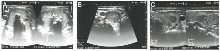 This set of grayscale ultrasound images (Figures A, B, and C) provides a diagnostic assessment of bilateral thyroid nodules in a patient with suspected medullary thyroid carcinoma (MTC). Image A displays the right thyroid lobe containing a large, dominant nodule (35 x 29 x 41 mm) characterized by heterogeneous echogenicity and internal macrocalcifications, which appear as bright echogenic foci with posterior acoustic shadowing. This lesion is classified as EU-TIRADS 4. Image B shows a second, smaller hypoechoic nodule (22 mm) in the right lobe, also classified as EU-TIRADS 4. Image C depicts the left thyroid lobe containing a 9 x 7 x 9 mm hypoechoic nodule with irregular margins, assigned a higher risk category of EU-TIRADS 5. These findings illustrate the sonographic presentation of multifocal thyroid lesions in the context of MEN2A syndrome. The variations in echogenicity, calcification patterns, and margin definition are key diagnostic features used for risk stratification and determining the necessity for fine-needle aspiration (FNA) biopsy.