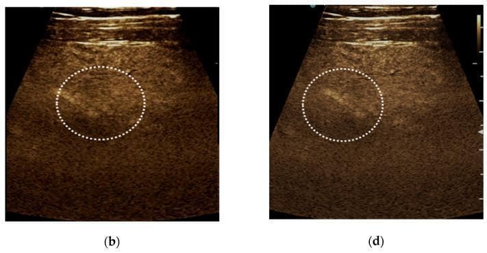 Two side-by-side contrast-enhanced ultrasound (CEUS) images (labeled b and d) demonstrating the enhancement pattern of a small liver lesion in a patient with hepatitis C-related cirrhosis. Image (b) shows the arterial phase, where the focal liver lesion (highlighted within a dotted white circle) exhibits isoenhancement relative to the surrounding liver parenchyma. Image (d) shows the late phase, where the same subcapsular lesion maintains isoenhancement, with no evidence of contrast washout. The background liver shows a nodular surface and heterogeneous echotexture characteristic of cirrhotic remodeling. The absence of arterial hyperenhancement and late-phase washout characterizes this lesion as a regenerative nodule, classified as CEUS LI-RADS 2 (probably benign). This diagnostic imaging series is critical for differentiating benign regenerative nodules from hepatocellular carcinoma in high-risk cirrhotic populations.