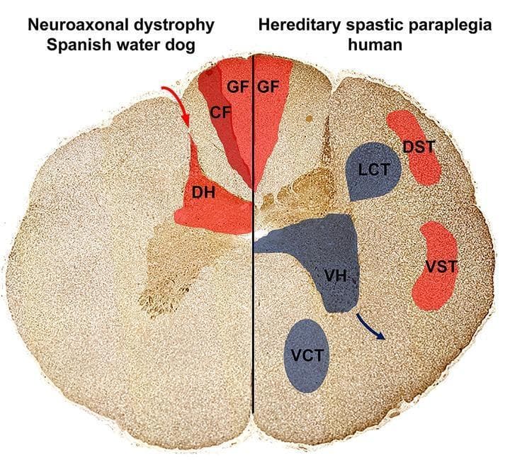 This Comparison Diagram presents a cross-sectional illustration of the spinal cord, contrasting the localization of axonal spheroids and neuronal loss in Neuroaxonal Dystrophy (NAD) and Hereditary Spastic Paraplegia (HSP). The diagram is split into two halves: the left represents a Spanish Water Dog with NAD, and the right represents human HSP.
Ascending sensory pathways are highlighted in red, including the Gracile Fasciculus (GF), Cuneate Fasciculus (CF), and Dorsal Horn (DH) on the NAD side, and GF, Dorsal Spinocerebellar Tract (DST), and Ventral Spinocerebellar Tract (VST) on the HSP side. Descending motor pathways, affected only in the HSP model, are highlighted in blue, depicting the Lateral Corticospinal Tract (LCT), Ventral Corticospinal Tract (VCT), and Ventral Horn (VH).
The visual demonstrates that in NAD, pathology is restricted to sensory, ascending tracts in the dorsal funiculus and dorsal horn. In contrast, human HSP shows involvement of both sensory pathways and descending motor pathways (pyramidal tracts and ventral horns). This diagram illustrates the pathophysiology of upper motor neuron and sensory system degeneration relevant to neurology and neurohistology.