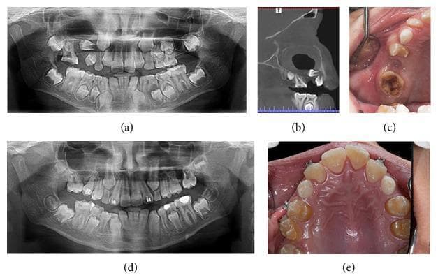 This composite of clinical and diagnostic images documents a case of a dentigerous cyst in the right maxilla and its resolution over 27 months. (a) Initial panoramic radiograph reveals a large, well-defined radiolucency associated with the crown of an unerupted maxillary tooth, typical of a dentigerous cyst. (b) Coronal CT image shows the cystic lesion's expansion within the maxillary sinus region and its relationship to the surrounding cortical bone and developing teeth. (c) Initial intraoral photograph displays a localized defect and swelling in the right maxillary alveolar ridge with visible tooth decay. (d) Follow-up panoramic radiograph at 27 months demonstrates complete bony remodeling and opacification of the previously cystic area, with permanent teeth continuing their eruption into a more normalized alignment. (e) Post-treatment intraoral view shows a fully healed, intact maxillary arch with healthy soft tissue contours and the successful preservation and eruption of teeth in the affected quadrant. The case illustrates the principles of pediatric oral surgery and the regenerative capacity of alveolar bone following cyst management.