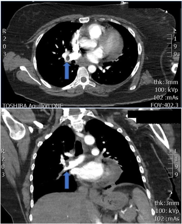 This diagnostic image consists of two views from a Contrast-Enhanced Computed Tomography Pulmonary Angiogram (CTPA): an axial slice (top) and a coronal reconstruction (bottom). The imaging demonstrates a critical finding in the pulmonary vasculature of the right lung. A prominent blue arrow in both views points to a well-defined, hypoattenuating filling defect within the right lower lobar artery, characteristic of an acute occlusive pulmonary embolism (PE). The thrombus is surrounded by high-density intravenous contrast, and the vessel appears moderately distended proximal to the occlusion. Mediastinal window settings show the heart, great vessels, and thoracic vertebrae. The lung parenchyma visualized in the background appears relatively clear without evidence of wedge-shaped infarction (Hampton's hump) or significant pleural effusion in this specific plane. This image serves as a classic educational example for identifying large-vessel pulmonary thromboembolism and understanding the importance of CTPA in diagnosing acute respiratory distress and tachycardia in a clinical setting.