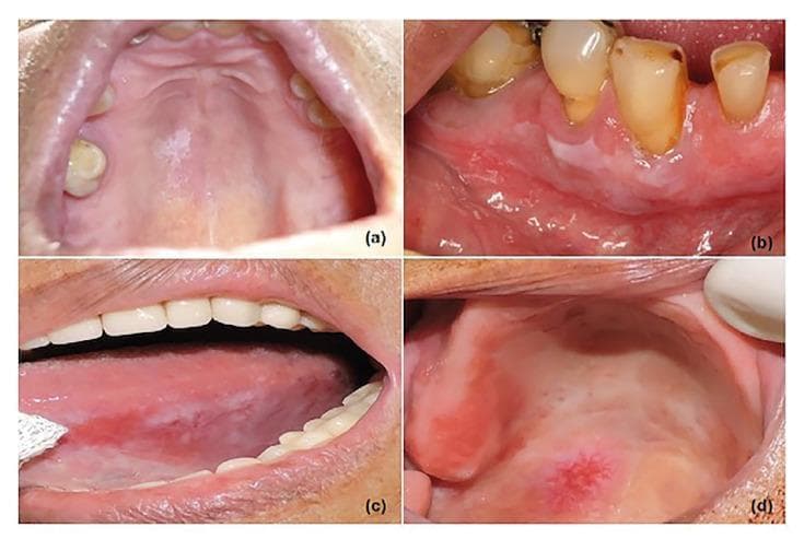 This composite of four clinical photographs illustrates various presentations of oral leukoplakia (OL) across different intraoral anatomical sites. Image (a) shows a single, homogeneous white patch on the hard palate. Image (b) demonstrates a flat, homogeneous white lesion involving the right inferior gingiva. Image (c) presents a nonhomogeneous leukoplakia on the left lateral border of the tongue, characterized by extensive white and reddish patches (erythroleukoplakia) with irregular surface texture, indicating a high risk of malignancy. Image (d) displays a mixed red and white lesion on the palate, featuring a central granular erythematous area surrounded by diffuse white leukoplakic changes. These images serve as educational tools for distinguishing between homogeneous and nonhomogeneous clinical subtypes of oral potentially malignant disorders (OPMDs). The collection highlights the importance of morphological assessment (color variation, texture, and border definition) and anatomical location in evaluating the risk of dysplasia and malignant transformation in oral lesions.