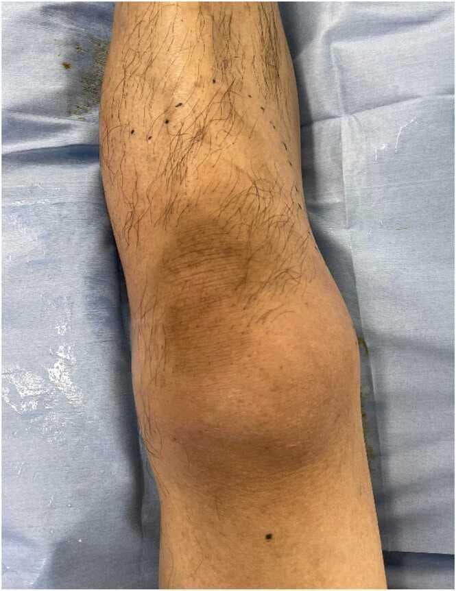 This clinical photograph shows the anterior view of a patient's left leg, including the distal thigh, knee, and proximal lower leg, resting on a blue medical drape. The image demonstrates a primary finding of diffuse, mild erythema (redness) extending from the thigh down to the shin. The erythema is most concentrated and visible over the patellar region (knee), presenting as a dusky, pinkish-tan discoloration. There is no visible evidence of joint effusion, gross swelling, bullae, or skin necrosis at this stage. Tiny black markings are visible on the skin, likely surgical or clinical landmarks used to track the progression of the redness. This visual finding is significant in the context of early-stage necrotizing fasciitis or cellulitis, particularly highlighting cases where clinical pain and tenderness out of proportion to visible skin changes (erythema) are key diagnostic indicators of deep tissue infection.