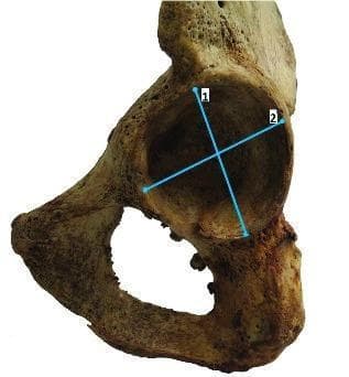 A clinical photograph of a human os coxae (hip bone) specimen, focusing on the lateral aspect of the acetabulum. The image demonstrates the anatomical landmarks used for skeletal morphometry and sex determination in forensic anthropology or osteology. Two blue measurement lines are superimposed within the acetabular fossa: line '1' indicates the vertical acetabular diameter, extending from the superior rim to the inferior margin; line '2' represents the transverse acetabular diameter, oriented perpendicularly to line '1'. The surrounding cortical bone exhibits a weathered, brownish-yellow appearance typical of dry bone specimens. Visible structures include the acetabular rim, the lunate surface, the obturator foramen located inferiorly, and portions of the ilium, ischium, and pubis. This visual is designed to illustrate standardized methods for quantifying pelvic morphology to assist in clinical research or archaeological assessment.