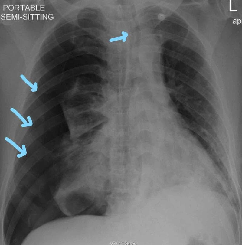 This diagnostic image is a portable anteroposterior (AP) chest X-ray of a patient in a semi-sitting position, demonstrating a large right-sided pneumothorax. The right hemithorax shows a significant area of hyperlucency (increased darkness) in the peripheral zone, characterized by the complete absence of bronchovascular lung markings. Three light blue arrows point to the visible visceral pleural line, which outlines the collapsed right lung parenchyma. The mediastinal structures and the trachea (indicated by a fourth blue arrow) are moderately shifted toward the left side, suggesting a mass effect due to positive pressure within the right pleural space. Bilateral patchy opacities are also visible in the remaining lung fields, consistent with underlying pulmonary pathology such as COVID-19 pneumonia or airspace disease. This visual is clinically significant for teaching the identification of pneumothorax, visceral pleural line visualization, and secondary signs of tension such as mediastinal shift.