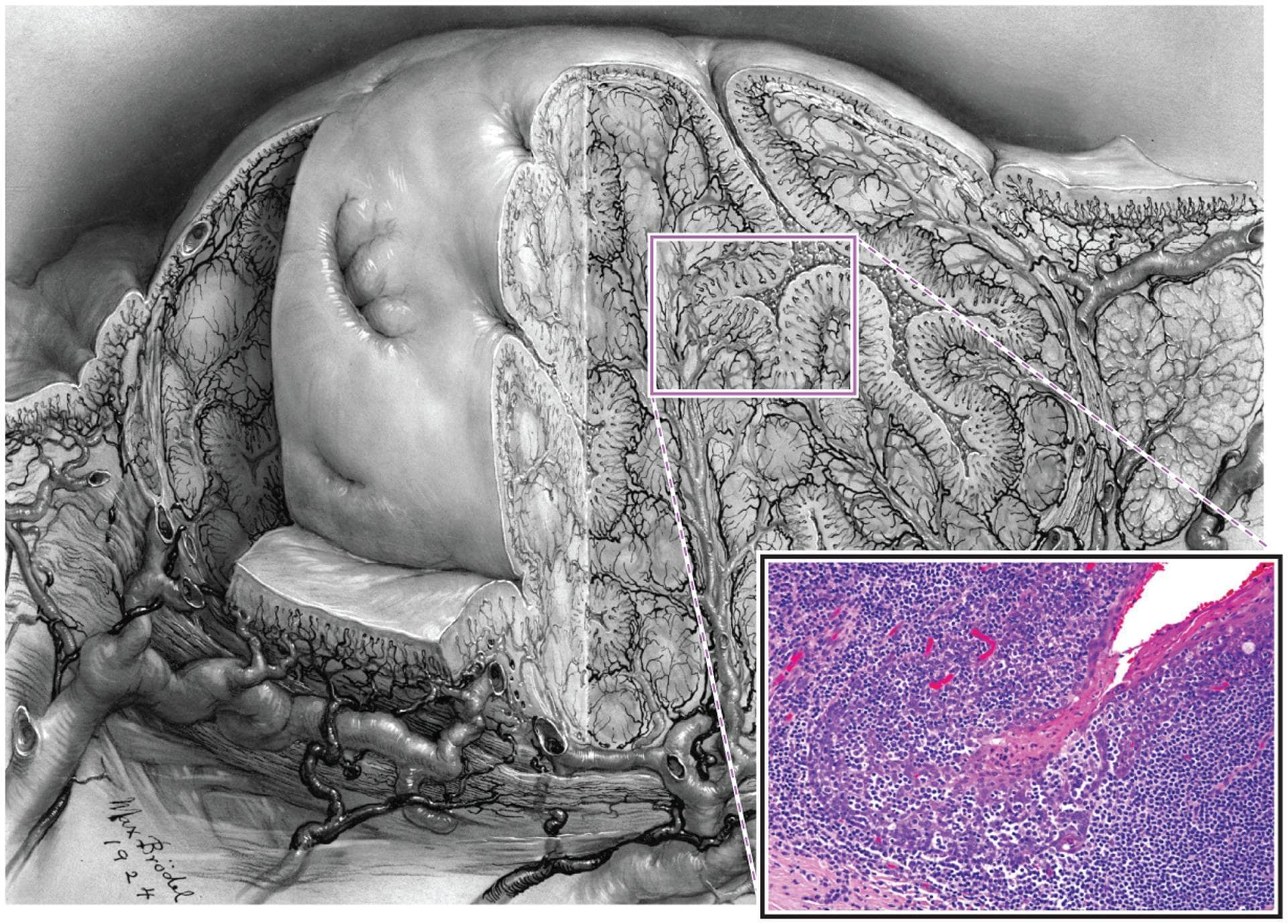 This composite educational image illustrates the gross and microscopic anatomy of a palatine tonsil. The primary visual is a detailed medical drawing showing a cross-sectional view of the tonsil, highlighting its complex architecture characterized by numerous deep, branching invaginations known as tonsillar crypts. These crypts significantly expand the surface area for antigen processing within the oropharynx. The drawing also depicts the underlying vascular supply. An inset provides a high-magnification histological view (H&E stain) of the reticulated epithelium lining a tonsillar crypt. This specialized epithelium demonstrates heavy infiltration by lymphocytes (lymphoepithelium), which partially obscures the underlying basaloid squamous cells. This structural arrangement facilitates the transport of foreign antigens to the dense lymphoid tissue of Waldeyer's ring. The content is suitable for medical education regarding head and neck anatomy, immunology, and the pathogenesis of HPV-related oropharyngeal squamous cell carcinoma, which often originates within these occult crypt environments.