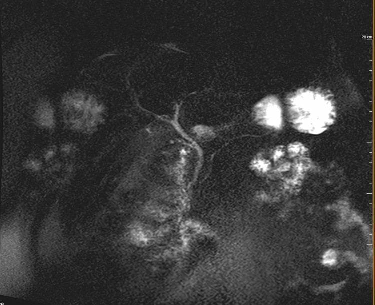 This diagnostic image is a Magnetic Resonance Cholangiopancreatography (MRCP) scan, a specialized MRI modality used to visualize the biliary and pancreatic ducts. The image provides a clear view of the extrahepatic biliary tree, showing a common bile duct (CBD) of normal caliber and a visible pancreatic duct. Notably, there is a remnant cystic duct present, which is consistent with the patient's history of a prior cholecystectomy. The biliary tree appears smooth without evidence of filling defects, such as choledocholithiasis (bile duct stones), or significant ductal dilation (strictures). The high signal intensity typical of fluid-filled structures on T2-weighted MRCP sequences allows for the assessment of ductal patency and morphology. This visual is representative of a normal postoperative biliary anatomy in a clinical workup for acute pancreatitis, where biliary obstruction has been ruled out as the primary etiology.