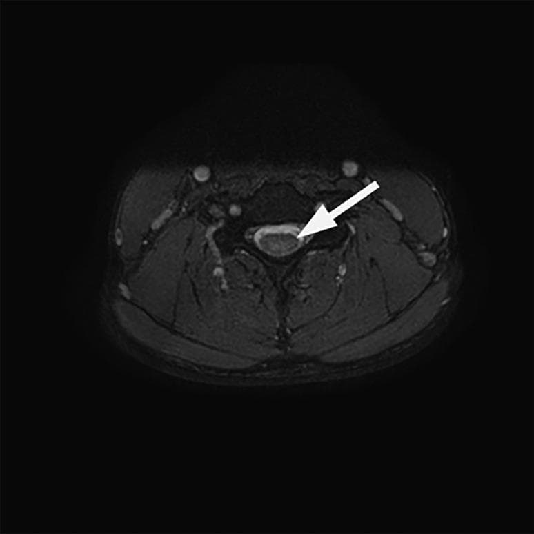 An axial T2-weighted Magnetic Resonance Imaging (MRI) scan of the cervical spine at the C5 vertebral level. The image demonstrates a well-defined spinal cord situated centrally within the spinal canal. A prominent white arrow points to a localized area of increased T2 signal intensity (hyperintensity) within the dorsal (posterior) columns. This radiographic finding is characteristic of subacute combined degeneration of the spinal cord, often associated with vitamin B12 deficiency or nitrous oxide toxicity. The surrounding anatomical structures, including the vertebral body, dark-appearing cerebrospinal fluid (CSF), and paraspinal soft tissues, are visible in the cross-sectional view. The hyperintensity specifically affects the posterior white matter tracts, illustrating the selective pathology typically seen in demyelinating processes of the dorsal columns.