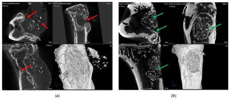 This comparative micro-computed tomography (μ-CT) study illustrates the pathophysiology of osteomyelitis and subsequent bone regeneration in a rat tibia model. Section (a) displays an untreated control group at 8 weeks post-infection with Staphylococcus aureus, showing significant structural pathology including ectopic bone growth (indicated by red arrows), narrowing of the medullary marrow space, and the formation of a sinus tract and pus-filled fibrous capsule. Section (b) demonstrates the therapeutic outcome 8 weeks after implantation of a vancomycin-loaded polymer/bioglass (BG) bone void-filling putty. This treated group exhibits successful infection eradication and advanced bone healing, characterized by the formation of new cortical and cancellous bone within the previous drilling site (indicated by green arrows). The images provide high-resolution cross-sectional and 3D reconstructions to demonstrate the efficacy of antibiotic-loaded scaffolds in treating orthopedic infections and promoting osteogenesis. This visual serves as an educational resource for medical microbiology, orthopedics, and biomaterials engineering.
