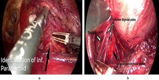 Two-panel endoscopic intraoperative photograph showcasing a thyroidectomy procedure. Panel (a) illustrates the dissection of the lower thyroid pole using laparoscopic instruments, including a blunt-tipped grasper and a vessel sealer. A black arrow indicates the identification of the right inferior parathyroid gland within a field of dissected vascular soft tissue. Panel (b) provides a detailed anatomical view of the left surgical field, featuring the trachea (labeled as a ridged, pale tubular structure), the inferior thyroid veins (thin longitudinal vessels), and the left inferior parathyroid gland (a distinct, rounded, reddish-brown structure). The images emphasize the preservation of the inferior parathyroid glands and their relationship to thyroid vasculature and the trachea during neck surgery. This educational material is suitable for surgical residency training, specifically focusing on endocrine surgery techniques and cervical anatomy preservation.