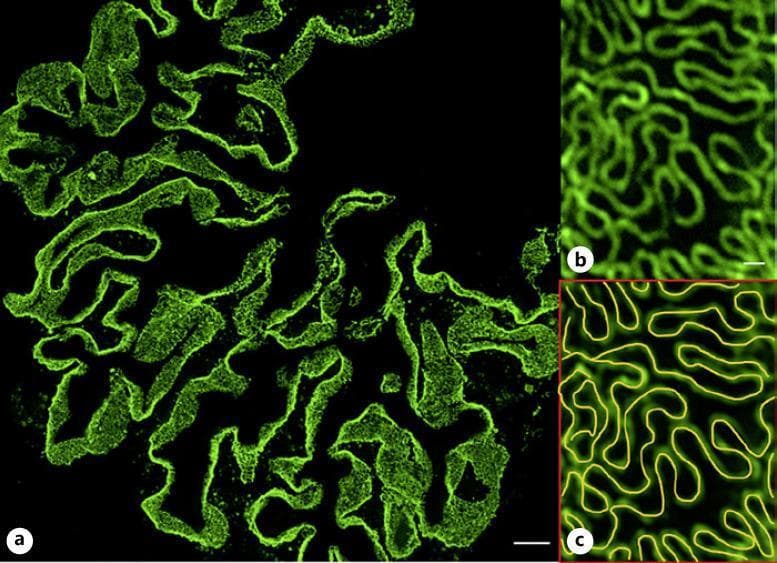 This diagnostic image displays a super-resolved immunofluorescence micrograph of a glomerular cross-section, demonstrating the renal filtration barrier's ultrastructure. Panel (a) shows an overview of the entire glomerulus where capillary loops are outlined by nephrin staining, a critical protein located in the diaphragm of podocyte filtration slits. Panel (b) provides a high-magnification view, resolving the interdigitating morphology of individual podocyte foot processes as bright green, curvilinear patterns. Panel (c) illustrates the application of the Podocyte Exact Morphology Measurement Procedure (PEMP) algorithm, which traces these filtration slits with yellow lines to calculate the filtration slit density (FSD). This quantitative morphometric analysis is used to objectively evaluate foot process effacement in various glomerulopathies. The visualization highlights the intricate relationship between podocyte anatomy and glomerular filtration function, transitioning from low-power architectural orientation to high-resolution quantification of the glomerular basement membrane's epithelial covering. Scale bars: 10 μm (overview), 200 nm (magnification).