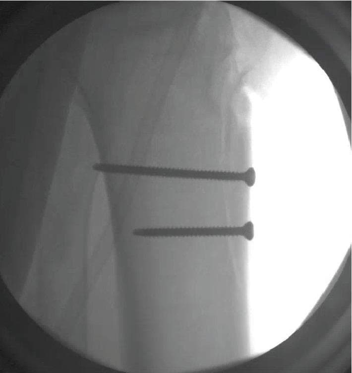 This intraoperative lateral fluoroscopic image demonstrates the surgical fixation of a tibial tubercle fracture. Two radiopaque orthopedic screws are visualized within the proximal tibia, providing internal fixation of the tubercle fragment. The screws are oriented parallel to each other in an anterior-to-posterior trajectory. The superior screw exhibits a bicortical configuration, with its tip clearly penetrating the posterior cortex of the tibial shaft. Both implants are fully threaded, consistent with cortical lag screws used to achieve anatomical reduction and interfragmentary compression. The anatomical landmarks of the proximal tibia and the radiopaque hardware are well-defined against the fluoroscopic background, confirming stable implant positioning and adequate fracture realignment. This imaging is characteristic of an Open Reduction Internal Fixation (ORIF) procedure for traumatic extensor mechanism injuries of the knee.