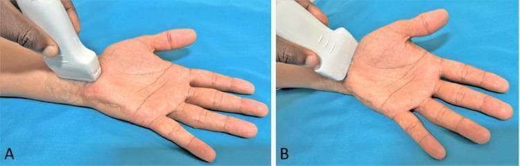 Two-panel clinical photograph demonstrating the positioning of a high-frequency linear ultrasound transducer for the evaluation of the carpal tunnel and median nerve at the wrist. The patient’s hand is in a supinated position with the palm facing upward and fingers relaxed. In Panel A (Longitudinal View), the transducer is oriented parallel to the long axis of the forearm and wrist, allowing for longitudinal visualization of the median nerve and flexor tendons as they pass deep to the flexor retinaculum. In Panel B (Transverse View), the transducer is rotated 90 degrees and placed perpendicular to the long axis of the forearm at the level of the proximal carpal tunnel (the 'inlet'). This view is essential for measuring the cross-sectional area (CSA) of the median nerve and assessing for pathology such as nerve compression, bifid median nerve, or persistent median artery. This imaging technique is a gold standard for the diagnostic evaluation of Carpal Tunnel Syndrome (CTS).