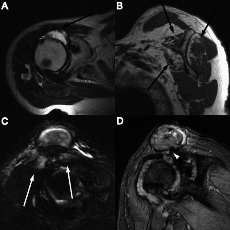 This composite diagnostic image features four MRI views (A-D) of a human shoulder, illustrating advanced degenerative joint disease and rotator cuff pathology. Panels A and B are axial and coronal sections showing a massive rotator cuff tear accompanied by severe muscle atrophy. Black arrows indicate fatty infiltration and volume loss in the supraspinatus, infraspinatus, and subscapularis muscles. Panel C highlights the acromioclavicular (AC) joint with white arrows pointing to osteoarthritic changes, including joint space narrowing and subchondral irregularities. Panel D is a T2-weighted MRI demonstrating a 'Geyser sign' (white arrowhead), where a large synovial cyst communicates directly with a markedly degenerated glenohumeral joint through a full-thickness rotator cuff defect. The images collectively demonstrate the progression of chronic rotator cuff insufficiency leading to secondary osteoarthritis and superior joint fluid leakage. This material is suitable for orthopedic and radiology education regarding shoulder instability and end-stage cuff tear arthropathy.