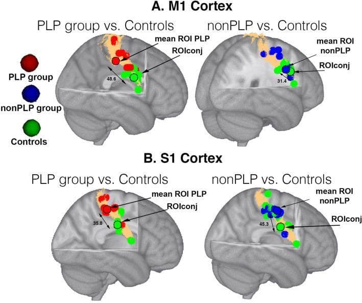 This diagnostic neuroimaging figure displays individual and group-level regions of interest (ROIs) mapped onto a 3D MNI152 brain template, focusing on the primary motor cortex (M1, Panel A) and primary somatosensory cortex (S1, Panel B). The visualization compares three experimental groups: Phantom Limb Pain (PLP, red), non-phantom limb pain (nonPLP, blue), and healthy controls (green). Copper-colored surface masks highlight cortical areas defined by the Juelich atlas. Small colored spheres represent peak coordinates for individual subjects, while spheres with black contours indicate the mean group ROI. A specific 'ROIconj' (conjunction ROI) is identified as the area where control activations overlap. Double-headed arrows with numerical values quantify cortical distances in millimeters (mm) between mean ROIs and the conjunction area. The image illustrates cortical reorganization and spatial shifts in neural activity within the sensorimotor cortex associated with amputation and chronic phantom limb pain, serving as a study of functional neuroanatomy and maladaptive plasticity.