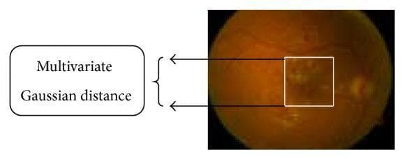 This clinical photograph displays a digital fundus image used for ophthalmological diagnostic analysis, specifically focused on diabetic retinopathy. The fundus exhibits a mottled orange-brown pigmentation with visible retinal vasculature. A white square bounding box demarcates a region of interest containing localized pathological changes, including exudates or textured pigmentation variations suggestive of disease manifestation. To the left of the image, an annotation box titled 'Multivariate Gaussian distance' with arrows pointing to the marked region illustrates a computational approach used in the Diabetic Fundus Image Recuperation (DFIR) method. The visual demonstrates the application of digital image processing to assess disease severity and depth, specifically within the optic cup or macular region. The educational focus is on the integration of clinical imaging with algorithmic classification (like the Spiral Basis Function) to objectively rank retinopathy progression and determine the spatial depth of affected retinal areas.