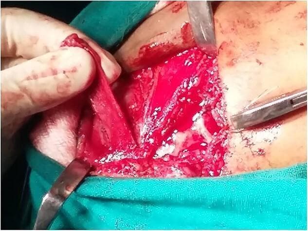This clinical photograph captures an intraoperative view of a maxillofacial surgical procedure, specifically an interpositional gap arthroplasty for temporomandibular joint (TMJ) ankylosis. The image shows a pre-auricular surgical approach with deep tissue dissection. A surgeon's gloved hand is visible, elevating and manipulating a temporalis myofascial flap—a pedicled graft consisting of temporalis muscle and its overlying fascia. This flap is being prepared for interposition into a surgically created gap between the glenoid fossa and the mandibular ramus to prevent re-ankylosis and facilitate joint mobility. Multiple surgical instruments are in use, including a malleable retractor and a hemostat or needle holder, to maintain exposure of the operative field. The surgical site demonstrates the typical appearance of vascularized tissue and minor hemorrhage expected during deep cranial-facial dissection. This visual illustrates key steps in reconstructive jaw surgery, emphasizing the use of autologous local flaps to restore functional articulation in patients with severe trismus.