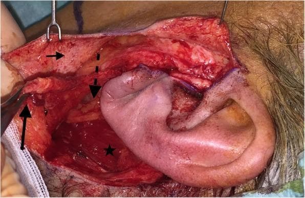 This clinical intraoperative photograph displays a left-sided parotidectomy field utilizing a modified facelift incision (MFI). The image illustrates the distinct surgical layers and anatomical structures exposed during the procedure. A thin superficial skin flap (indicated by a small horizontal arrow) is retracted superiorly using surgical hooks. Below this, a secondary, thicker flap consisting of the superficial musculoaponeurotic system (SMAS) is being manipulated with forceps (marked by a solid vertical arrow). Deep to the SMAS layer, the intermittent dashed arrow points toward the parotid capsule area. The sternocleidomastoid muscle (indicated by a star) is visible in the posterior-inferior aspect of the surgical bed. The ear is positioned centrally and slightly to the right of the dissection field, serving as a primary landmark for the MFI approach. The photograph demonstrates the anatomical plane between the subcutaneous tissue and the SMAS, as well as the surgical exposure of the parotid region required for tumor resection and subsequent reconstructive advancement of the SMAS flap.