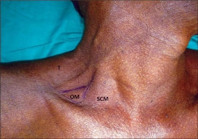 A clinical photograph of a human neck demonstrating surface anatomy landmarks for a lateral regional anesthesia approach. The image shows the right posterior triangle of the neck with skin markings in purple ink. The markings delineate the posterior border of the sternocleidomastoid muscle (SCM), the anterior border of the trapezius muscle (T), and the inferior belly of the omohyoid muscle (OM) as it crosses the triangle. These boundaries define the supraclavicular and occipital triangles within the posterior cervical region. The landmarks are used to identify the needle insertion point for interscalene or supraclavicular brachial plexus blocks, typically located approximately 1 cm superior to the clavicle. This visual serves as a topographical guide for medical education in anesthesiology and clinical anatomy, highlighting the relationship between palpable muscular structures and underlying neural plexuses.