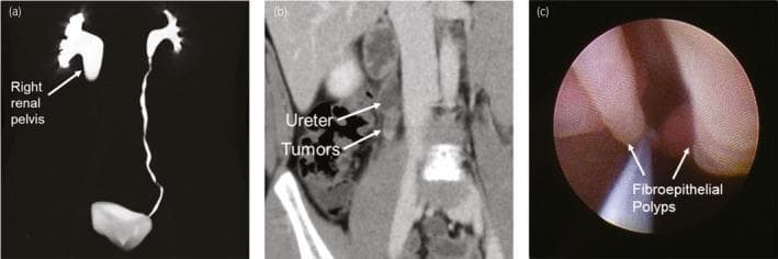 A multi-panel medical image illustrating the diagnosis of ureteral fibroepithelial polyps (UFEPs) causing obstruction. Panel (a) is a 3D reconstructed enhanced CT urogram demonstrating severe right-sided grade 3 hydronephrosis with a dilated renal pelvis and a sudden cutoff at the ureteropelvic junction (UPJ), while the left urinary tract remains normal. Panel (b) shows a coronal view of an enhanced CT scan identifying soft tissue masses (tumors) within the right proximal ureter at the level of the UPJ obstruction. Panel (c) provides a diagnostic ureteroscopy (URS) view showing multiple, smooth, pinkish, elongated finger-like masses projecting into the ureteral lumen, characteristic of benign fibroepithelial polyps. The image captures the diagnostic pathway from radiological identification of high-grade hydronephrosis to endoscopic visualization of the underlying etiology in a pediatric or adult urology context.