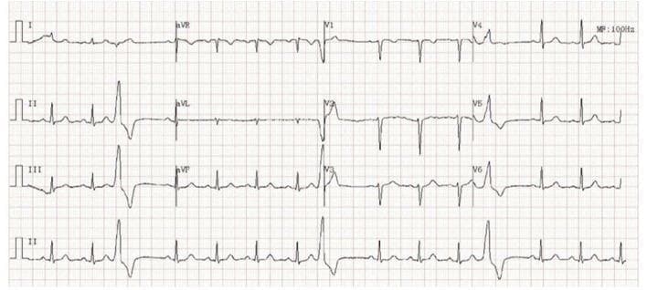 This diagnostic image is a 12-lead electrocardiogram (ECG) tracing recorded at a standard paper speed and gain. The ECG demonstrates a baseline underlying normal sinus rhythm characterized by regular P waves with a consistent morphology preceding narrow QRS complexes. Interspersed within the sinus rhythm are frequent premature ventricular complexes (PVCs). These ectopic beats are distinguished by their wide, bizarre QRS morphology, increased amplitude compared to the sinus beats, and the absence of a preceding P wave. The PVCs show a secondary T-wave change (discordance), where the T wave is oriented in the opposite direction to the main QRS deflection. The image serves as a clinical example of ventricular ectopy and is suitable for educational purposes regarding cardiac arrhythmia identification and ECG rhythm analysis in cardiology and emergency medicine contexts.