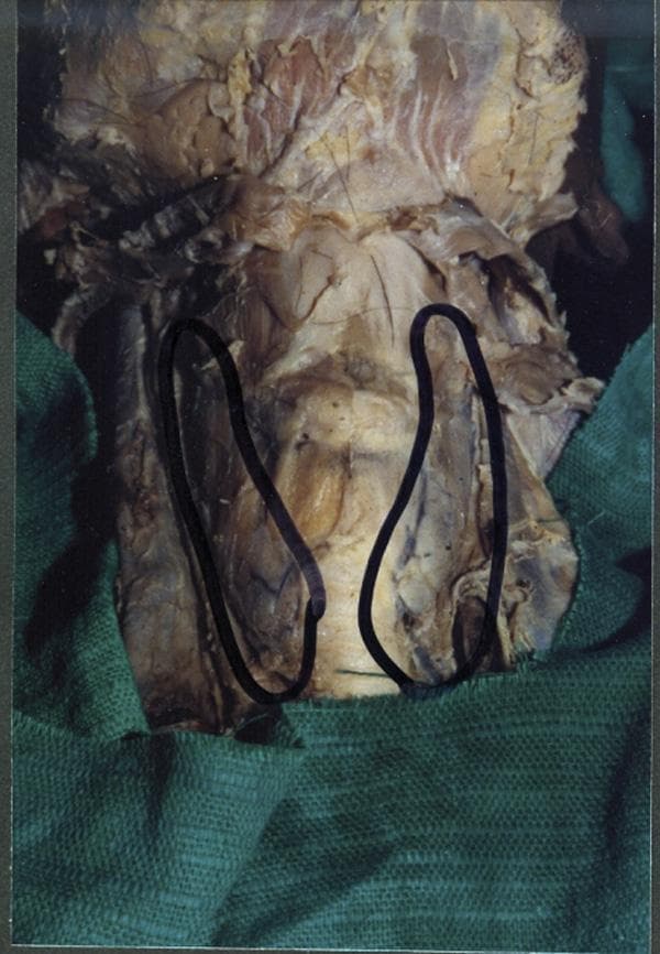 This clinical photograph of a gross anatomical specimen shows a midline dissection of the human neck, highlighting a congenital variation of the thyroid gland. The image depicts the thyroid gland consisting of two distinct, independent lateral lobes (outlined in black) positioned on either side of the trachea. Notably, there is a complete absence (agenesis) of the thyroid isthmus, which normally connects the two lobes across the second to fourth tracheal rings. In the area where the isthmus typically resides, only a thin, translucent layer of pre-tracheal fascia is visible covering the anterior surface of the trachea. The specimen demonstrates the anatomical relationship between the glandular lobes, the respiratory pathway, and the surrounding connective tissue structures. This visual is significant for medical education in endocrinology, anatomy, and surgery, as it illustrates a rare developmental anomaly where the median diverticulum of the thyroglossal duct failed to form the glandular bridge between the bifurcated lobes.