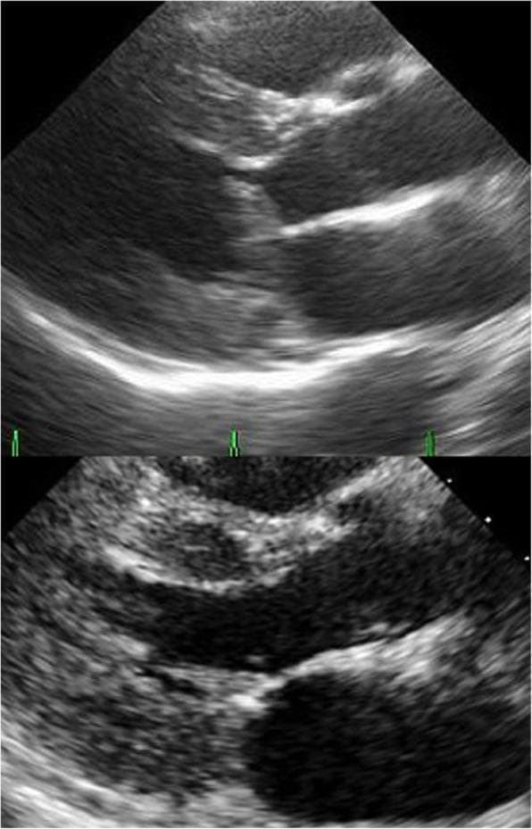 This diagnostic image comparison consists of two transthoracic echocardiography frames in the parasternal long-axis view, illustrating preoperative and postoperative states of the mitral valve. The top frame shows the preoperative condition characterized by Systolic Anterior Motion (SAM) of the anterior mitral leaflet. An elongated A2 segment is visible contacting the hypertrophied interventricular septum (17 mm thickness) during systole, resulting in significant left ventricular outflow tract (LVOT) obstruction. The bottom frame displays the postoperative result following surgical intervention. It demonstrates a clear, unobstructed LVOT with the absence of SAM. The mitral valve leaflets now exhibit normal coaptation and positioning, with no visible contact between the anterior leaflet and the septum. These images serve as an educational comparison for identifying mechanical LVOT obstruction in hypertrophic cardiomyopathy or related valvular pathologies, highlighting the anatomical markers of successful surgical repair.
