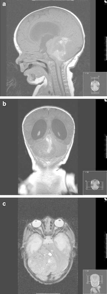 This diagnostic image consists of a three-panel MRI series (sagittal, axial, and coronal planes) of a pediatric patient's head, demonstrating a large posterior fossa tumor. The sagittal view (a) shows a heterogeneous, partially contrast-enhancing mass occupying the cerebellum and compressing the brainstem, with evidence of downward cerebellar tonsillar herniation through the foramen magnum. The coronal view (b) illustrates significant supratentorial hydrocephalus with marked enlargement of the lateral ventricles secondary to obstructive mass effect. The axial view (c) displays the tumor’s lateral extent within the right posterior fossa, causing a distinct leftward midline shift and displacement of the brainstem. These findings are characteristic of aggressive pediatric brain tumors, such as ependymoblastoma or medulloblastoma, which present with increased intracranial pressure and mass effect on critical infratentorial structures.