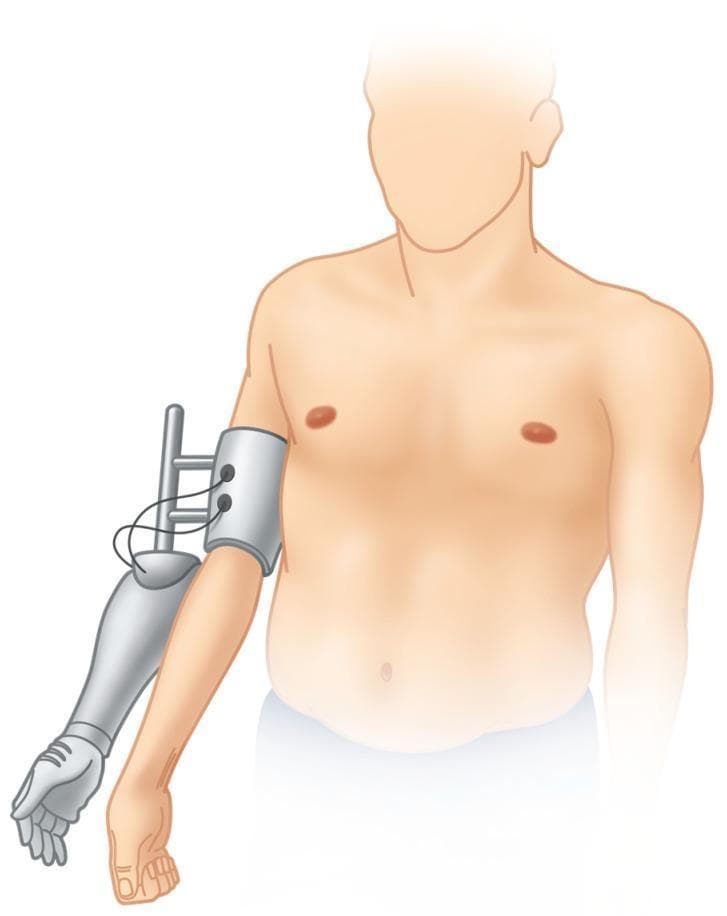 An anatomical illustration depicting a bionic reconstruction concept for a patient with a global brachial plexus injury. The diagram shows a fair-skinned male torso with a functionless biological arm and an attached hybrid prosthetic device. The prosthetic consists of a metallic upper-arm socket or cuff equipped with surface electromyography (sEMG) sensors and wiring, which interface with the underlying musculature of the denervated limb. Extending from this cuff is a mechanical frame that supports a prosthetic forearm and an articulated hand with segmented fingers. The device is positioned alongside the original, non-functional limb to allow for functional testing and signal training before a potential elective amputation. This setup is used in clinical rehabilitation to evaluate if myoelectric control of a mechatronic device can provide superior hand function compared to the original compromised extremity. The illustration emphasizes the biotechnological interface between biological signal sites and prosthetic control systems.