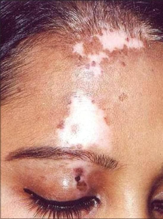 Clinical photograph of the forehead and periocular region of a patient with segmental vitiligo. The image demonstrates well-demarcated, irregularly shaped depigmented (white) macules and patches localized to the upper left quadrant of the face. A large, prominent patch of depigmentation is visible on the central-left forehead, extending toward the hairline. Scattered throughout and adjacent to the depigmented areas are smaller hyperpigmented macules, characteristic of repigmentation clusters following medical or surgical intervention (such as punch grafting). On the left upper eyelid, a cluster of dark, pigmented macules is evident within a localized area of skin alteration, possibly indicating the site of a therapeutic procedure or localized inflammation. The clinical presentation illustrates the dermatological manifestations of vitiligo and the resulting pigmentary variations during treatment monitoring in a dermatology setting.