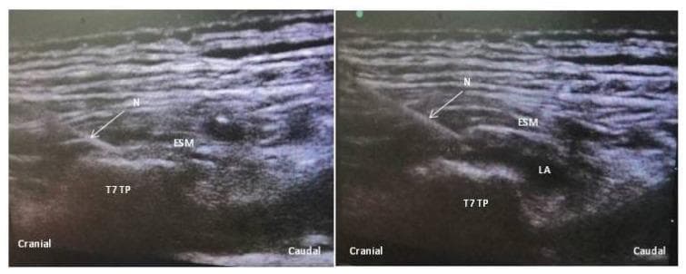 This diagnostic ultrasound image demonstrates the sonoanatomy of an Erector Spinae Plane (ESP) block at the level of the T7 thoracic vertebra. The image is presented in a sagittal view with cranial and caudal orientation markers. Key anatomical structures identified include the T7 transverse process (T7 TP), which appears as a hyperechoic, bony landmark with posterior acoustic shadowing, and the superficial erector spinae muscle (ESM), characterized by its striated echo texture. A hyperechoic needle (N) is visualized being advanced in a cranio-caudal direction through the ESM. In the post-injection frame, local anesthetic (LA) is seen as a hypoechoic (dark) fluid collection accumulating in the fascial plane deep to the ESM and superficial to the transverse process. The image illustrates the objective of the ESP block: the hydrodissection of the plane between the musculature and the bony processes to facilitate the cranial and caudal spread of anesthesia along the thoracic paravertebral space. This material is suitable for training in regional anesthesia, pain management, and ultrasound-guided procedural techniques.