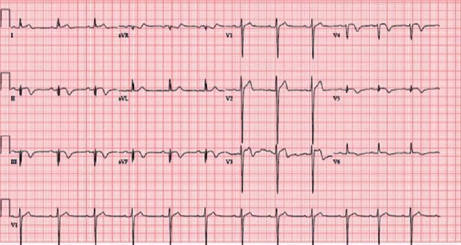 This diagnostic image is a standard 12-lead electrocardiogram (ECG) displayed on a red grid background, illustrating significant ischemic changes. The tracing demonstrates a sinus rhythm with a normal heart rate. Pathological findings include diffuse ST-segment and T-wave abnormalities across multiple leads. Specifically, deep T-wave inversions are evident in the lateral leads (I, aVL, V4-V6), inferior leads (II, III, aVF), and anterior leads (V2-V3). ST-segment depression is visible in leads I, aVL, and V4-V6, while slight ST-segment elevation is noted in lead V2. Additionally, the precordial leads (V1-V6) show poor R-wave progression, characterized by low R-wave amplitude in V1-V3 that does not appropriately increase toward the lateral leads. These findings are clinically significant for suggesting myocardial ischemia or injury, often associated with coronary artery pathology such as a left anterior descending (LAD) artery lesion. The ECG serves as a critical educational tool for identifying widespread ischemic patterns and abnormal ventricular depolarization.
