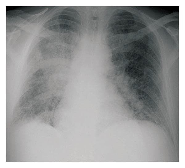 This diagnostic image is a posteroanterior (PA) chest radiograph demonstrating significant pulmonary pathology. The primary finding is a widespread, bilateral miliary pattern characterized by numerous, small (1–3 mm), well-defined nodular opacities distributed throughout both lung fields. There is a noticeable higher concentration of these nodules in the lower lung zones compared to the apices. Additionally, a large, dense, ill-defined focal opacity is visible in the right lower lobe, consistent with a progressive consolidation or mass-like lesion. The combination of a localized consolidated lesion and diffuse miliary dissemination in a patient with underlying immunosuppression (such as CLL) is highly suggestive of hematogenous spread of infection, like miliary tuberculosis or fungal diseases such as blastomycosis. The mediastinal shadow appears slightly widened, and the cardiac silhouette is within normal limits. This image serves as a classic educational example of miliary lung disease and rapid radiological progression of opportunistic pulmonary infections.