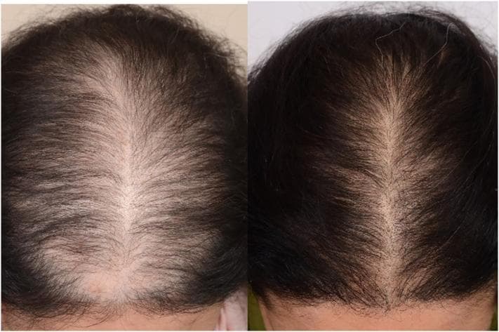 Clinical photograph (top view) demonstrating the scalp of a 31-year-old female with androgenetic alopecia (AGA), showing side-by-side 'before' and 'after' results following five platelet-rich plasma (PRP) treatment sessions over 4 months. The 'before' image illustrates a classic female pattern of hair loss, characterized by significant diffuse thinning across the central scalp, crown, and vertex, with a widened part line and high visibility of the underlying scalp. The hair strands appear fine and miniaturized. The 'after' image demonstrates clinical improvement, evidenced by increased hair density and follicular volume. There is a noticeable narrowing of the central part line and enhanced coverage of the scalp surface. This comparison highlights the efficacy of PRP as a therapeutic modality for non-scarring alopecia, illustrating its role in stimulating hair regrowth and improving hair shaft thickness in patients with hormonally-mediated hair loss.