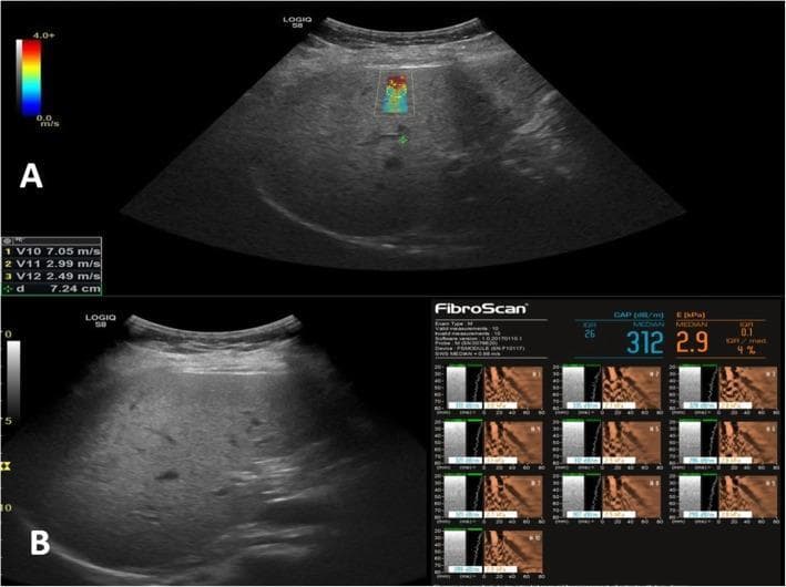 This composite diagnostic image demonstrates a comparative assessment of liver fibrosis in a 48-year-old female with chronic hepatitis B using two elastography modalities. Image A shows a 2D Shear Wave Elastography (SWE) examination. The top pane displays a B-mode ultrasound of the liver with a color-coded shear wave velocity map (ranging from 0.0 to 4.0+ m/s) overlaid on a region of interest. Numerical data indicates velocities (V10: 7.05 m/s, V11: 2.99 m/s, V12: 2.49 m/s) at a depth of 7.24 cm, which was interpreted as significant fibrosis (Metavir F2). Image B displays a Transient Elastography (FibroScan) report. The left side shows the B-mode ultrasound guide, while the right side presents quantitative data: a Controlled Attenuation Parameter (CAP) of 312 dB/m (indicating steatosis) and a liver stiffness measurement (E) of 2.9 kPa with an IQR/median of 4%. These FibroScan findings are consistent with no significant fibrosis (Metavir F0), illustrating a clinical discrepancy between SWE and TE results in the same patient. The visual serves to educate on non-invasive liver stiffness measurement techniques and the potential for overestimation in specific modalities.