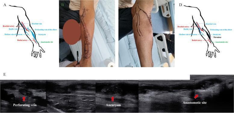 A multi-panel figure illustrating a thrombosed arteriovenous fistula (AVF) in a hemodialysis patient. (A) Anatomical diagram showing a radiocephalic AVF with an aneurysm in the median vein of the forearm and outflow through a perforating vein to the brachial vein. (B, C) Clinical photographs of the left upper limb with skin markings delineating a tortuous, dilated superficial venous pathway and visible distension consistent with venous aneurysms. (D) Schematic illustrating the location of a thrombus extending from the anastomotic site to the elbow. (E) Grayscale ultrasound images of the 'Perforating vein', 'Aneurysm', and 'Anastomotic site'. The ultrasound reveals dilated vascular lumens containing heterogeneous echogenic material, diagnostic of intraluminal thrombosis. The educational focus is on the clinical and radiological presentation of AVF complications, specifically aneurysm formation and subsequent thrombosis in a patient with end-stage renal disease.