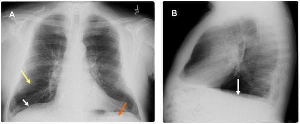 This diagnostic image displays a two-panel chest roentgenogram (X-ray) from a 65-year-old male, highlighting radiographic features of severe pulmonary emphysema and chronic obstructive pulmonary disease (COPD). Panel A presents a postero-anterior (PA) view, while Panel B provides a lateral view. Key findings include significant hyperinflation of the lung fields with marked flattening of the hemidiaphragms (indicated by white arrows), which loss their normal convex shape. In Panel A, a yellow arrow identifies areas of increased translucency and attenuation of vascular markings consistent with emphysematous parenchymal changes. A red arrow highlights the decreased zone of apposition, representing the diminished area where the diaphragm sits parallel to the inner rib cage. Panel B further illustrates the flattened diaphragmatic contour and an increased retrosternal clear space, reflecting an increased anterior-posterior thoracic diameter (barrel chest). These visual markers are clinically significant as they correlate with the mechanical basis of Hoover's sign, where the horizontal orientation of the diaphragm causes inward rib cage retraction during inspiration.