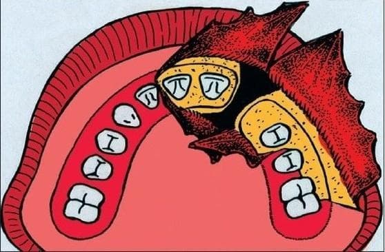This medical illustration depicts a surgical approach for alveolar bone grafting in a patient with a cleft palate. The anatomical diagram shows the maxillary dental arch with a visible interruption at the cleft site. Key features include the elevation of gingival and palatal mucoperiosteal flaps, represented in red with a textured surface, which are reflected to expose the underlying alveolar bone and the margins of the cleft. The teeth are shown in white, with specific markings (e.g., 'pi' and 'I' symbols) likely used as educational markers for tooth orientation or identification during the procedure. The surgical field highlights the preparation of the recipient site where cancellous bone graft material will be packed. The illustration demonstrates the clinical management of a vestibular fistula and the mobilization of nasal mucosa required to create a pocket for the graft. This diagram serves as an educational tool for maxillofacial and plastic surgery, focusing on the Gothenburg technique for secondary alveolar bone grafting.