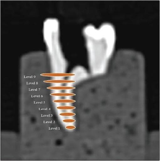 This diagnostic image is a Computed Tomography (CT) scan reconstruction of a human tooth specimen embedded in a mounting block, used for endodontic research. The visual demonstrates an anatomical diagram overlay illustrating the methodology for root canal scanning and analysis. Nine distinct axial section levels are identified, labeled sequentially from 'Level 1' at the apical third to 'Level 9' at the coronal orifice. Each level is highlighted by an orange elliptical marker that represents the cross-sectional plane of the root canal at that specific depth. The diagram shows the natural tapering morphology of the root canal, with the diameter of the orange markers progressively increasing from the narrow apex (Level 1) toward the wider coronal aspect (Level 9). This imaging protocol is clinically relevant for evaluating dental instrumentation techniques, measuring canal transportation, and assessing remaining dentinal thickness during endodontic therapy. The specimen is shown in a sagittal/coronal view, providing a clear vertical reference for the internal anatomy of the root system.