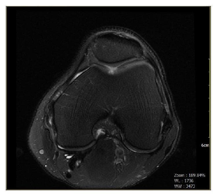 This diagnostic image is an axial cross-sectional MRI of the left knee joint, showcasing the patellofemoral compartment. The image reveals the patella positioned anterior to the femoral trochlea. Key pathological findings include mild patellofemoral joint osteoarthritis characterized by subtle subchondral bone signal changes and focal thinning of the articular cartilage. Specifically, a high-grade (Grade III-IV) chondromalacia defect is visible overlying the central femoral trochlear groove, where the cartilage surface appears irregular and diminished in thickness. The marrow signal within the patella and distal femur is largely preserved, though minor marginal osteophyte formation is noted. Surrounding soft tissues and ligamentous structures are visualized, with focal areas of increased signal intensity in the anterior soft tissues suggestive of localized edema or joint effusion. This imaging study is educationally significant for demonstrating traumatic and degenerative cartilage defects and the radiologic presentation of patellofemoral chondromalacia.