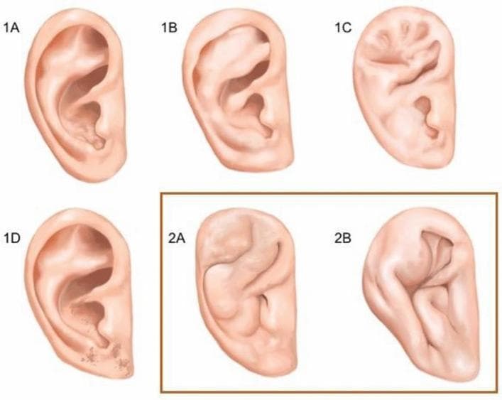This medical illustration presents the Yotsuyanagi classification system for cauliflower ear (auricular hematoma/deformity of the pinna), categorized into two primary types based on the preservation of the auricular outline. Type 1 deformities maintain a relatively normal external ear outline and are subdivided into four categories: 1A (localized deformity within the concha), 1B (involvement extending from the antihelix to the helix), 1C (generalized deformity affecting the entire internal ear architecture), and 1D (deformity associated with skin defects or scarring). Type 2 deformities, highlighted in the orange box, represent more severe stages where the overall auricular outline is significantly altered. Type 2A displays moderate structural integrity where a distorted but recognizable ear shape remains. Type 2B shows poor structural integrity with severe distortion and loss of the characteristic anatomical outline. This diagram is an educational resource for plastic surgery and sports medicine to grade the severity of chronic auricular trauma commonly seen in contact sports like judo or wrestling.