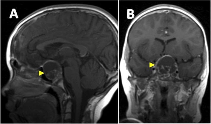 This diagnostic image consists of two panels showing T1-weighted Magnetic Resonance Imaging (MRI) of the brain with contrast. Panel A is a sagittal view, and Panel B is a coronal view. Both panels highlight a recurrent cystic lesion (indicated by a yellow arrowhead) located in the sellar and suprasellar regions, characteristic of a craniopharyngioma. The cyst is well-circumscribed, ovoid, and exhibits a hyperintense signal relative to the brain parenchyma, suggesting high protein content or contrast enhancement of the cyst wall. In the sagittal view, the mass is seen anterior to the brainstem, causing significant superior displacement and distortion of the third ventricle floor. In the coronal view, the cyst extends superiorly from the skull base towards the midline, exerting a mass effect on adjacent neuroanatomical structures including the optic chiasm region. These findings are clinically significant for monitoring post-radiotherapy recurrence of craniopharyngioma and assessing pressure effects on the ventricular system and visual pathways.