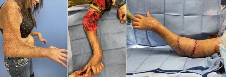 Clinical photographs depicting the pre-operative and intra-operative stages of burn scar contracture release and reconstruction. Left: A 32-year-old female presents with severe post-burn sequelae on the bilateral upper extremities. The skin demonstrates diffuse, mottled dyspigmentation and textural irregularities consistent with extensive scarring and previous split-thickness skin grafting (STSG). A rigid 90-degree flexion contracture of the elbow is evident. Middle: Intra-operative view showing a large soft tissue defect at the elbow following release of the burn scar and lacertus fascia, and lengthening of the biceps tendon. The surgical field reveals exposed deeper tissues prepared for reconstruction. Right: Post-reconstruction view showcasing a successful free Anterolateral Thigh (ALT) flap used to cover the 12x12 cm defect. The flap is secured with visible circumferential sutures at the elbow joint, and the limb is shown in improved extension. The case illustrates advanced plastic surgery techniques including contracture release and microsurgical free flap reconstruction for complex burn injuries.