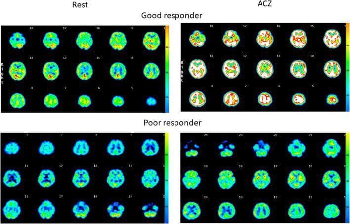 Comparison of quantitative Single-Photon Emission Computed Tomography (SPECT) axial brain scans evaluating regional cerebral blood flow (rCBF) and cerebrovascular reactivity (CVR). The image is divided into four sections: 'Rest' (baseline) and 'ACZ' (after Acetazolamide injection), comparing a 'Good responder' (upper panels) and a 'Poor responder' (lower panels). The upper panel shows axial slices of a patient with preserved CVR, demonstrating a diffuse, robust increase in signal intensity from baseline (green/blue) to post-ACZ challenge (yellow/red/white), indicating normal vasoreactivity. In contrast, the lower panel depicts a patient with a prior stroke and impaired CVR, showing minimal change in signal intensity and distribution between the rest and ACZ states, primarily maintaining low-intensity blue/green hues. A color scale on the right of each quadrant correlates warmer colors (yellow/red) with higher quantitative blood flow. This diagnostic image illustrates the assessment of hemodynamic reserve in cerebrovascular disease using pharmacological challenge.