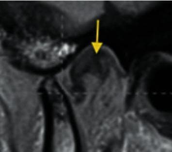 This diagnostic image is an MRI scan of the human temporomandibular joint (TMJ) in a sagittal view, demonstrating internal derangement. The primary anatomical structures visible include the mandibular condyle, the glenoid fossa of the temporal bone, and the articular disc. A yellow arrow points directly to the articular disc, which is abnormally positioned. Specifically, the image illustrates posterior disc displacement (PDD), where the posterior band of the disc is shifted behind its normal superior position relative to the condylar head, often described as being posterior to the 12 o'clock position on top of the condyle. This imaging is critical for evaluating TMJ disorders and orofacial pain, providing a clear visual contrast between the low-signal fibrocartilaginous disc and the adjacent bony and soft tissue structures. The pedagogical focus is the identification of directional disc displacement as a subset of TMJ pathologies.