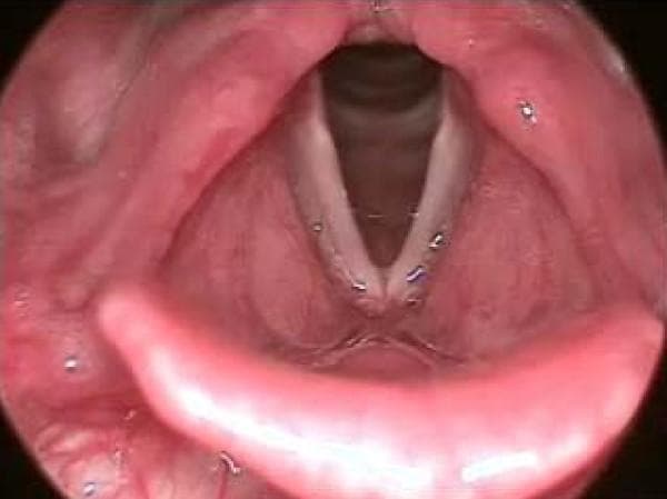 An endoscopic view of a normal human larynx, representing a baseline for clinical comparison with various voicing disorders. The diagnostic image displays the true vocal folds (vocal cords) as smooth, whitish-pink, and symmetrical structures. They are positioned in a V-shaped configuration, creating a clear triangular glottic opening that indicates the larynx is in a state of abduction (opening for respiration). The surrounding laryngeal mucosa and vestibular folds (false vocal folds) appear healthy, pink, and free of visible lesions, nodules, cysts, or inflammation. Key landmarks visible include the posterior commissure at the base of the 'V' and the surrounding subglottic space appearing dark in the background. This clinical photograph serves as an educational reference for normal laryngeal anatomy in the context of otolaryngology and speech-language pathology.